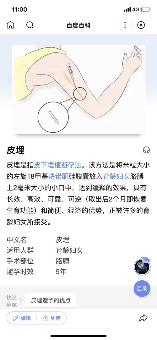 有姐妹了解皮埋这种避孕技术吗?有没有什么副作用?