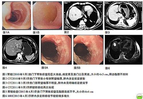 【转载】胃癌肝转移1例(1)